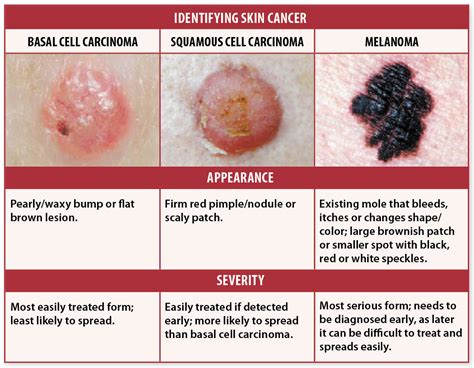 malignant skin cancer prognosis
